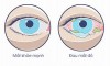 Đau mắt đỏ: Cách phòng ngừa và điều trị